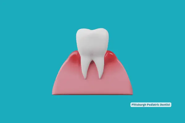 How to Treat Burned Gums From Teeth Whitening